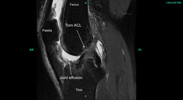 Resonancia magnética de la articulación de la rodilla derecha