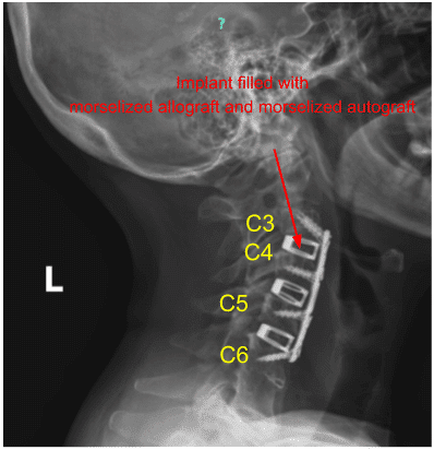 Radiografía de la vista sagital de la columna cervical