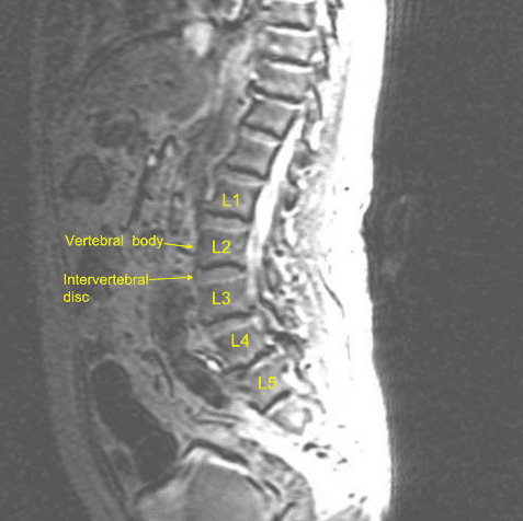 Vista sagital de la resonancia magnética lumbar preoperatoria