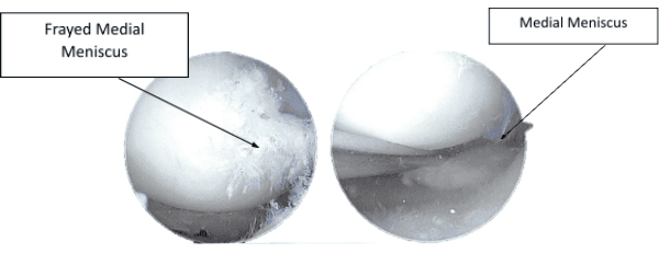 Figura 2.1. Imágenes de artroscopia intraoperatoria