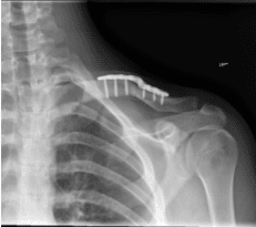 Resultados de la radiografía de 12 semanas de la clavícula izquierda tras la cirugía
