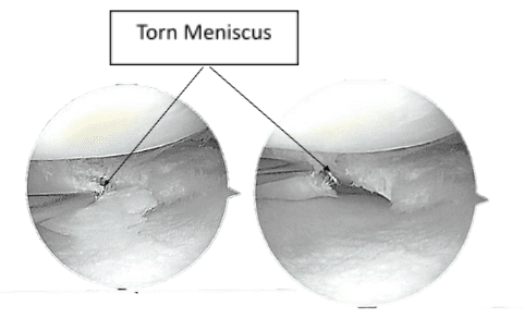 Figura 2.2. Imágenes de artroscopia intraoperatoria