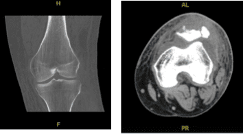 TC - Contraste de rodilla izquierda
