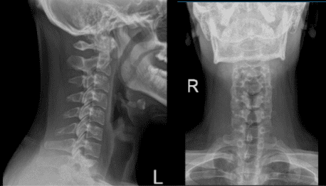 Radiografía de la columna cervical 2 vistas