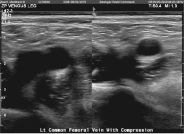 Extremidad inferior venosa Doppler izquierda