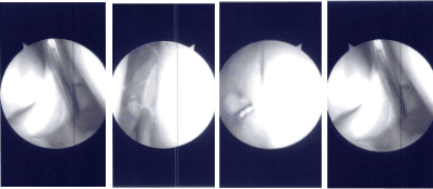 Intraoperative Arthroscopy Images