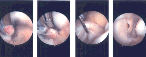 Intraoperative Arthroscopy Images