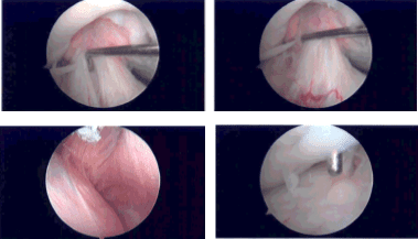 Imágenes de artroscopia intraoperatoria