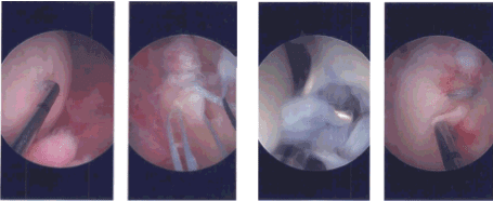 Imágenes de artroscopia intraoperatoria