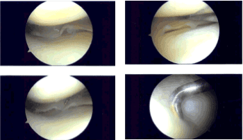 Imágenes de artroscopia intraoperatoria