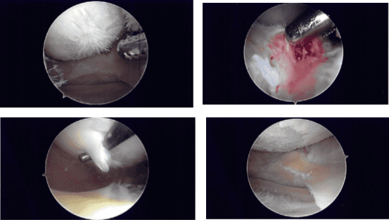 Intraoperative Arthroscopy Images