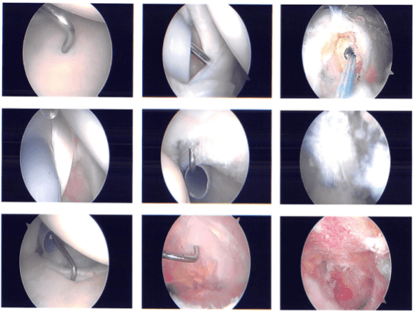 Intraoperative images