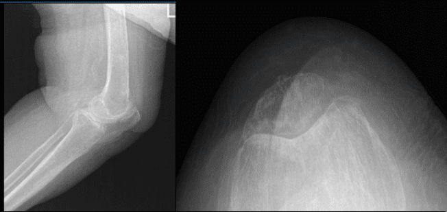 Radiografía de rodilla izquierda con vistas oblicuas 3