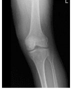 Radiografía de rodilla izquierda AP y vistas laterales con oblicuos 3