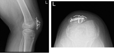 Radiografía de la rodilla izquierda con rótula