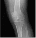 Radiografía de rodilla izquierda AP y lateral con vistas oblicuas