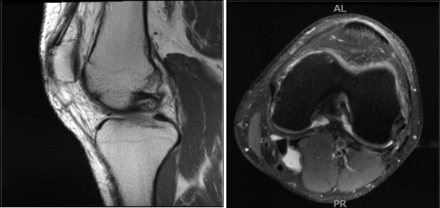 MRI-3T Rodilla Izquierda sin contraste