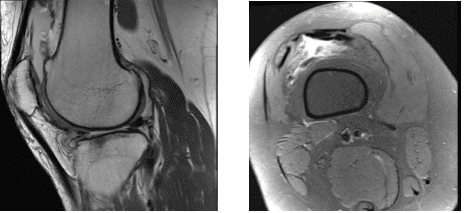 MRI-3T Rodilla Derecha sin Contraste