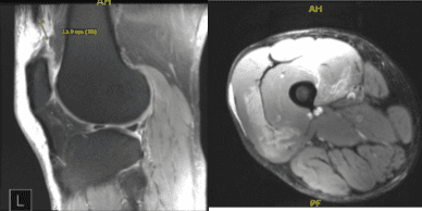 MRI-3T Rodilla Derecha sin contraste