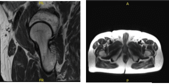 MRI-3T cadera derecha sin contraste