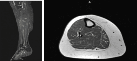 MRI- Right Calf Non-contrast