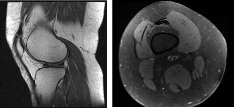 Resonancia magnética de rodilla derecha sin contraste