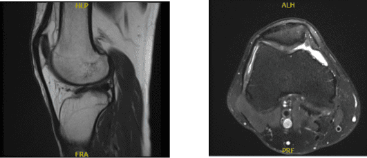 Resonancia magnética de rodilla derecha sin contraste