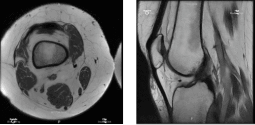 Resonancia magnética de rodilla derecha sin contraste