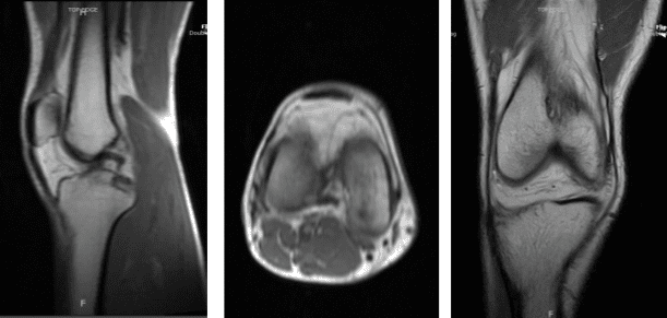Resonancia magnética de rodilla derecha sin contraste
