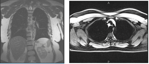 MRI chest without and with contrast