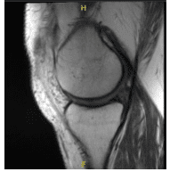 MRI presented to post operative visit, no visibility of the cyst