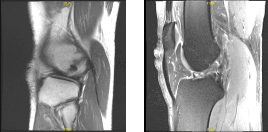 Resonancia magnética de rodilla derecha sin contraste