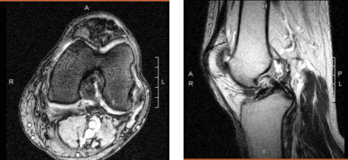 Imagen por resonancia magnética de la rodilla izquierda