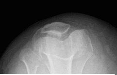 Horizonte de Patella