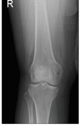 Radiografía de la rodilla derecha