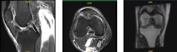 Resonancia magnética de rodilla derecha sin contraste