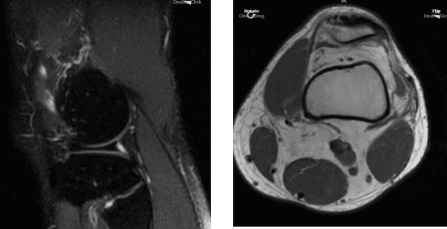 MRI Left Knee Non-contrast