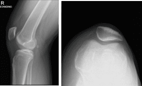 Radiografía de la rodilla derecha con rótula