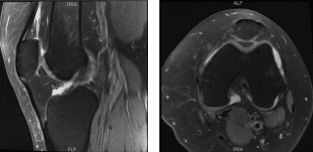 MRI-3 Rodilla izquierda sin contraste
