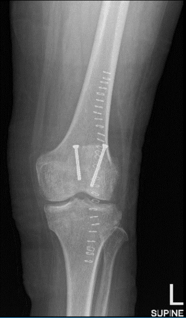 Radiografía de rodilla izquierda AP y lateral
