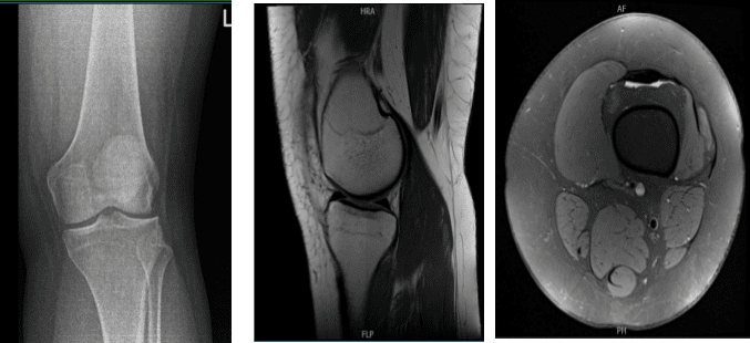 Resonancia magnética de la rodilla izquierda
