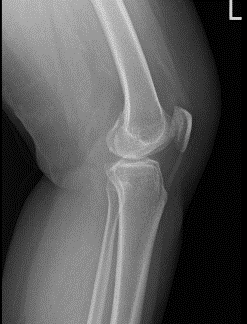 Radiografía de rodilla izquierda con vistas oblicuas 3