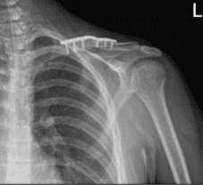 Resultados de la radiografía de 4 semanas de la clavícula izquierda tras la cirugía