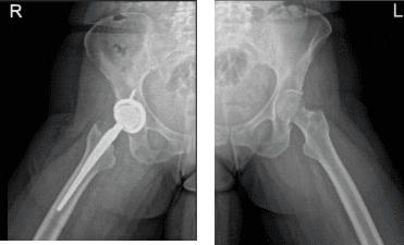 Cadera bilateral con pelvis 3 o 4 más vista