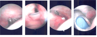 Imágenes artroscópicas intraoperatorias