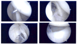 Imágenes artroscópicas intraoperatorias