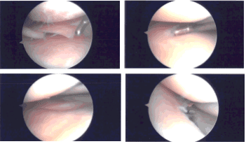 Imágenes de artroscopia intraoperatoria