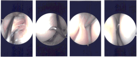 Imágenes de artroscopia intraoperatoria
