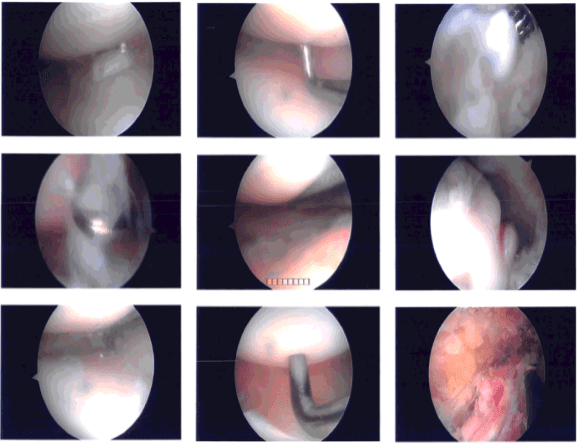 Intraoperative photo