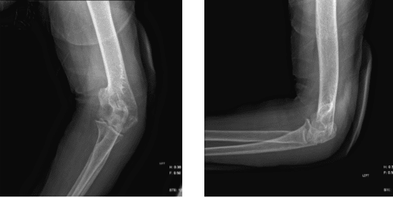 Radiografía del codo izquierdo